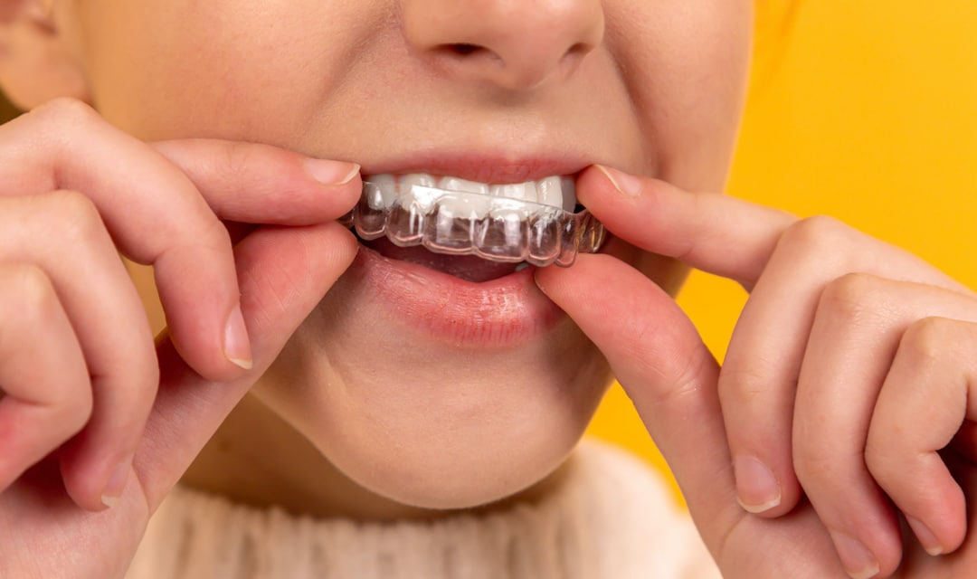 How to Make Your Retainer Fit Again at Home