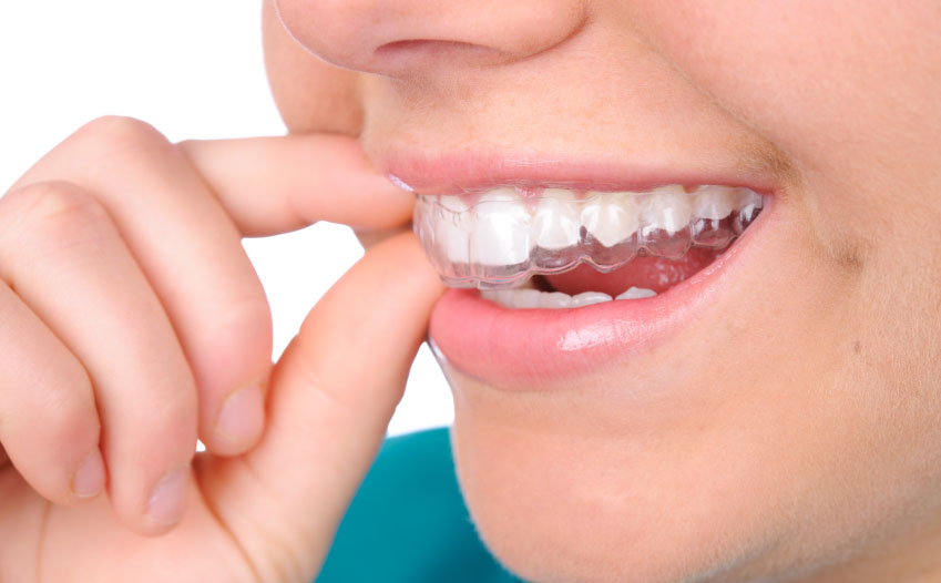 How to effectively clean a retainer for a better fit